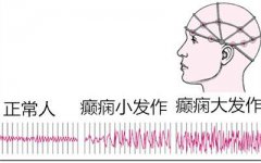 癫痫病的治疗