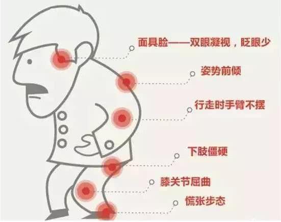 帕金森患者可以锻炼改善吗？